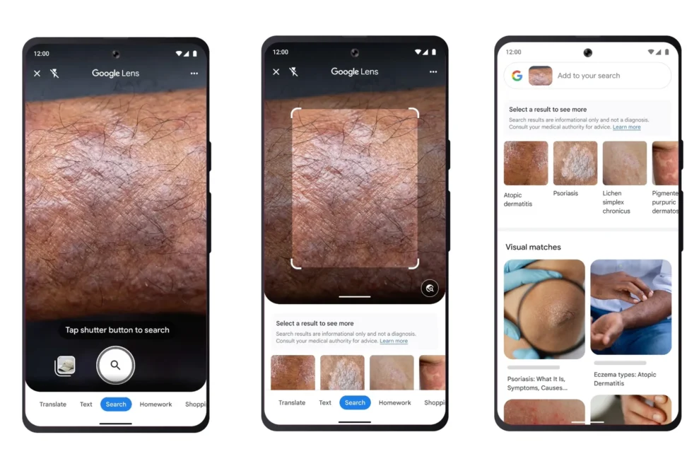 Google Lens kan nå identifisere dine hudproblemer 1