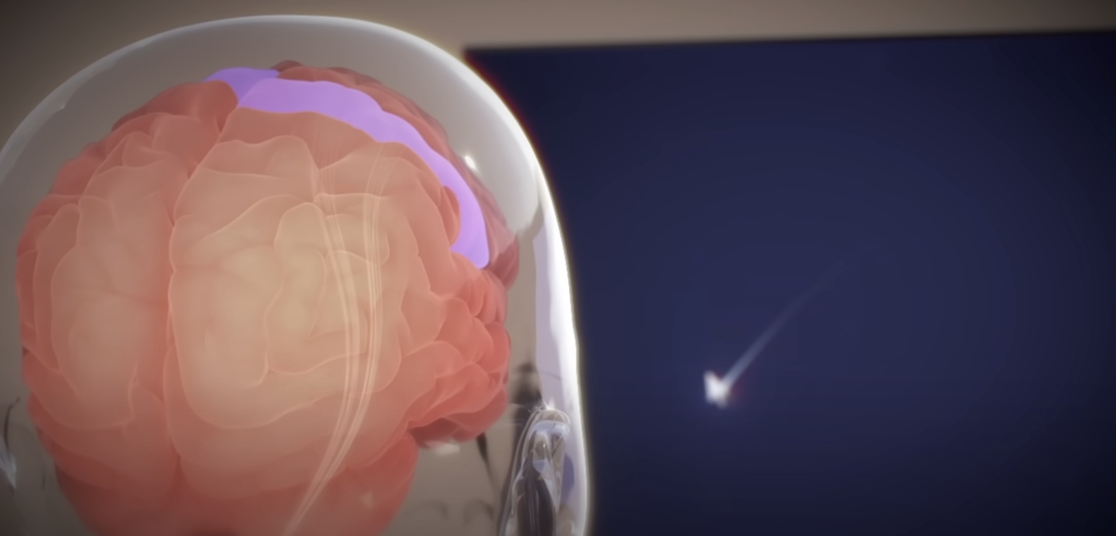 Första implantat-patienten använder hjärnkontroll